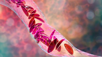 Drépanocytose : ce qui peut aider à mieux vivre avec la maladie